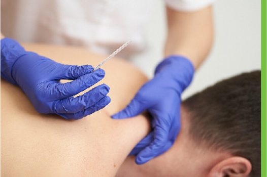 Home 4 DRY NEEDLING THERAPY