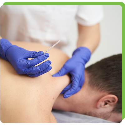 DRY NEEDLING THERAPY